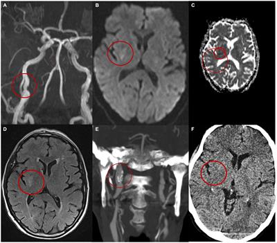 Investigating the pathophysiology and evolution of internal carotid dissection: a fluid–structure interaction simulation study